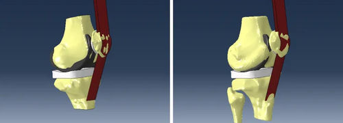 分析软件 - Abaqus Knee Simulator - SIMULIA - 模拟 / 建模 / 设计